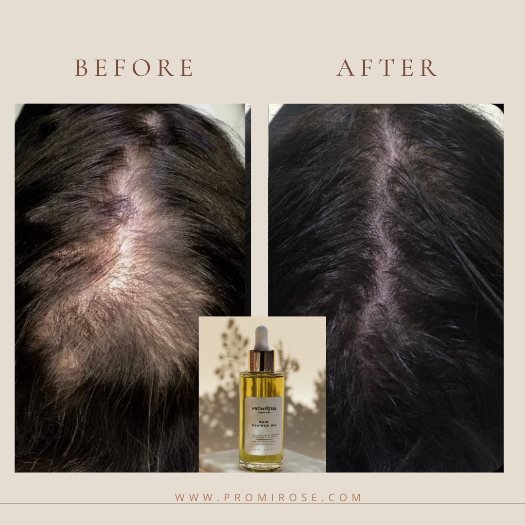Promirose Oil with Scalp Brush