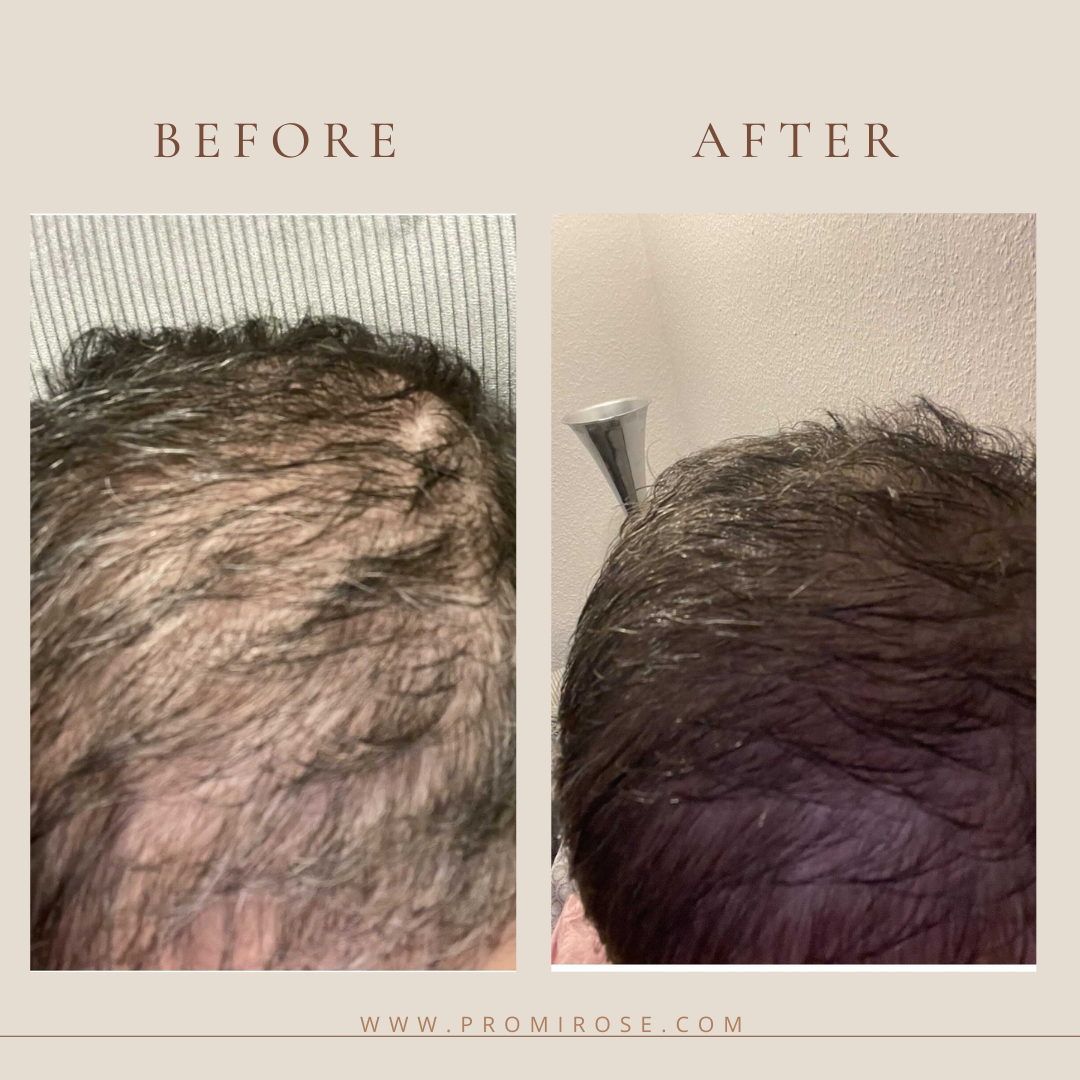 1 Natural hair growth oil PROMIROSE