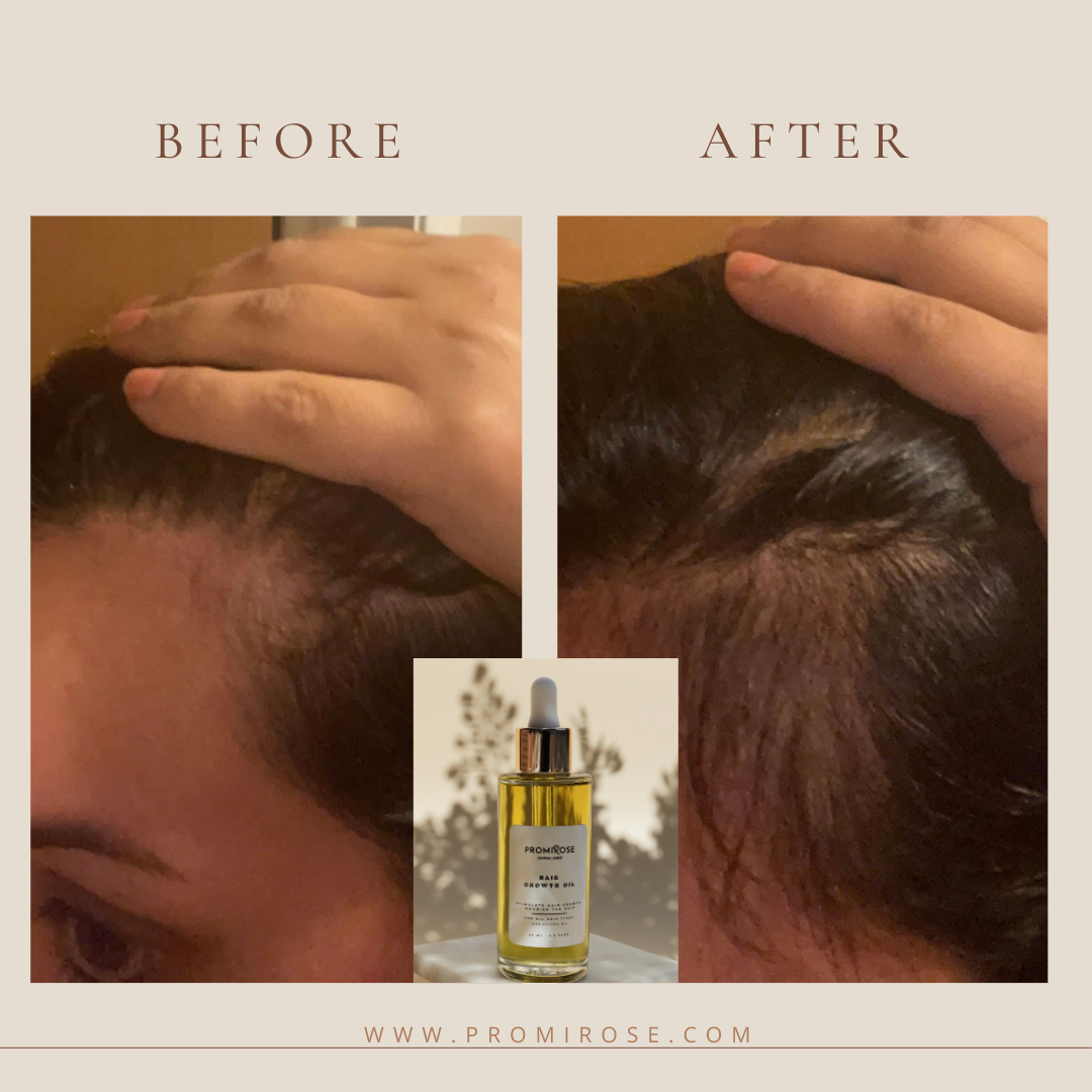 Promirose Oil with Scalp Brush