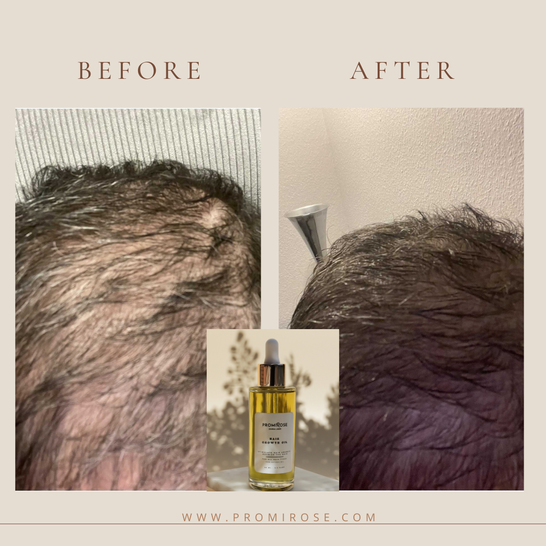 Promirose Oil with Scalp Brush