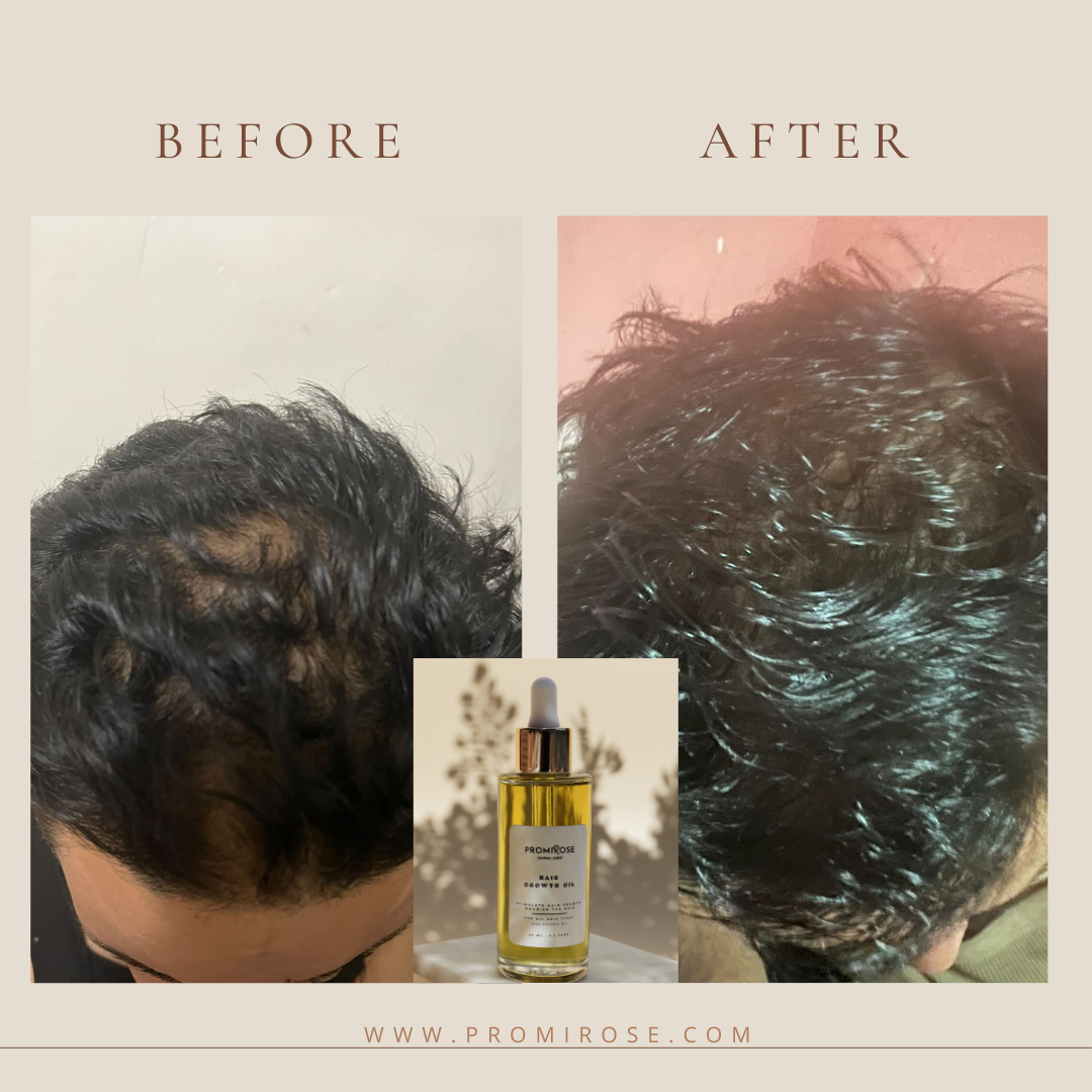 Promirose Oil with Scalp Brush
