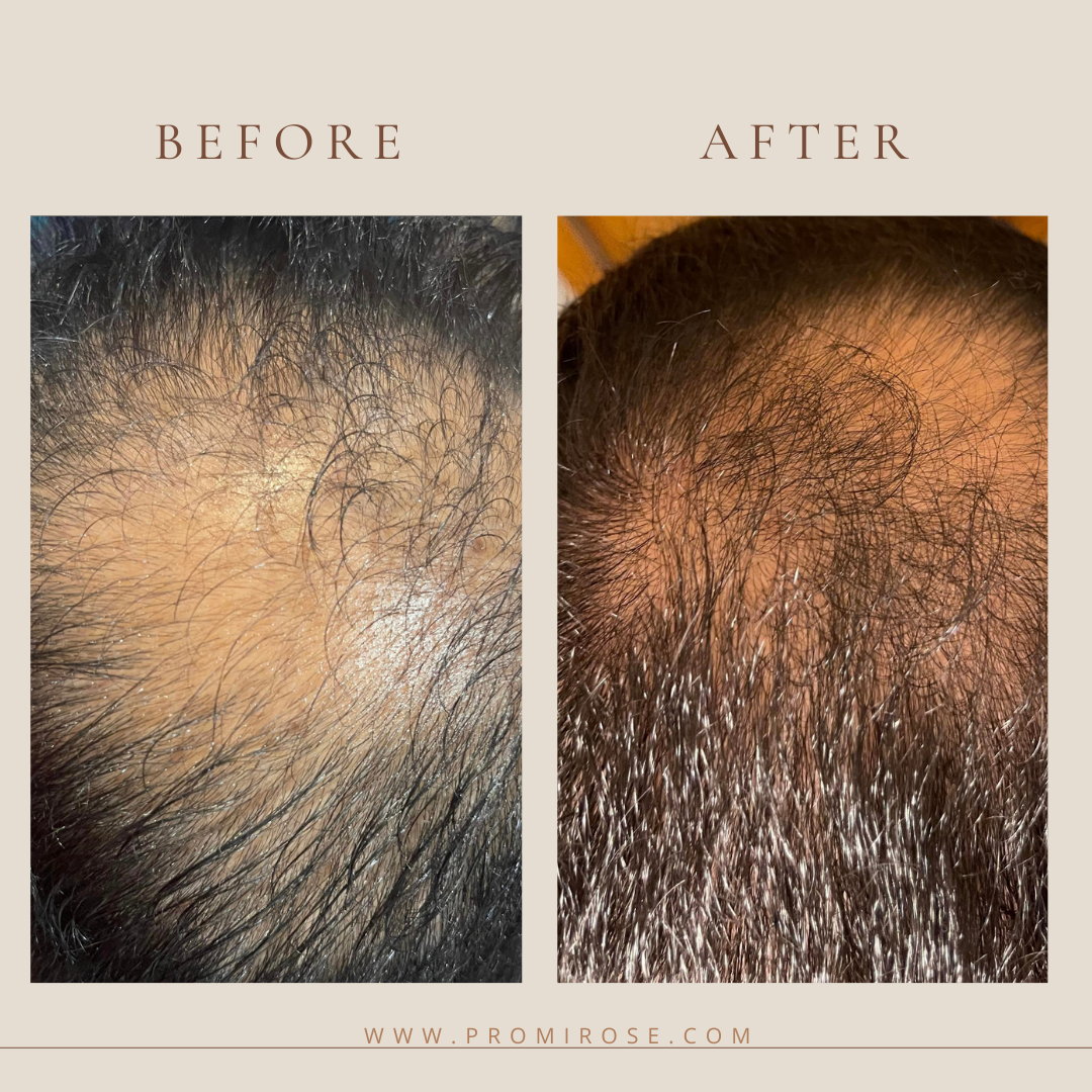 6 promirose hair growth oil