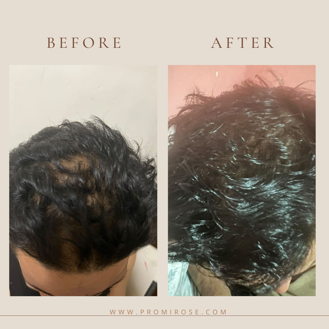 3 promirose hair growth oil